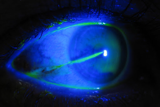 Skleralabrasion Fluorescein