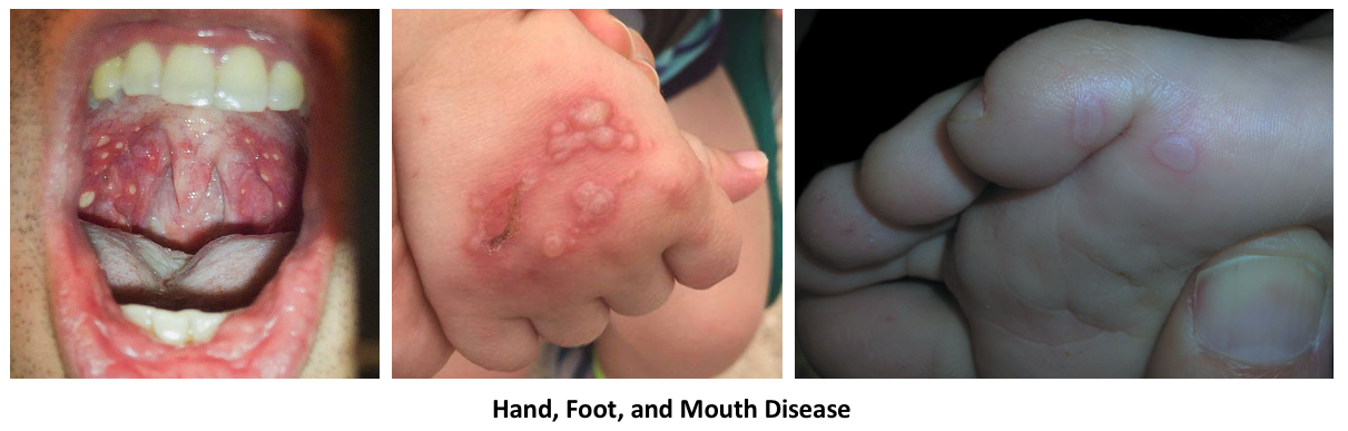 Hand Foot And Mouth Disease Coxsackievirus CodeHealth