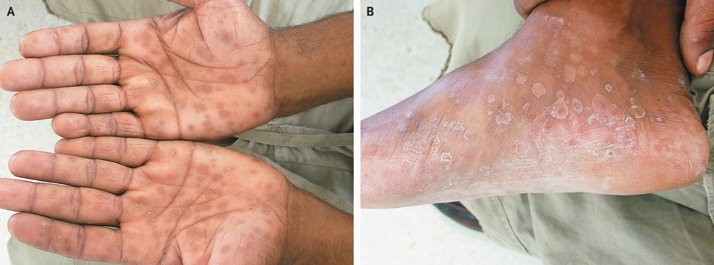 Maculopapular Rash On Palms & Soles Maculopapular Rash On Palms & Soles