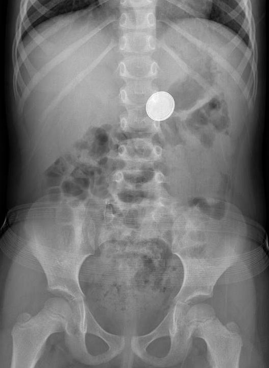 &quot;He Swallowed A Battery&quot;