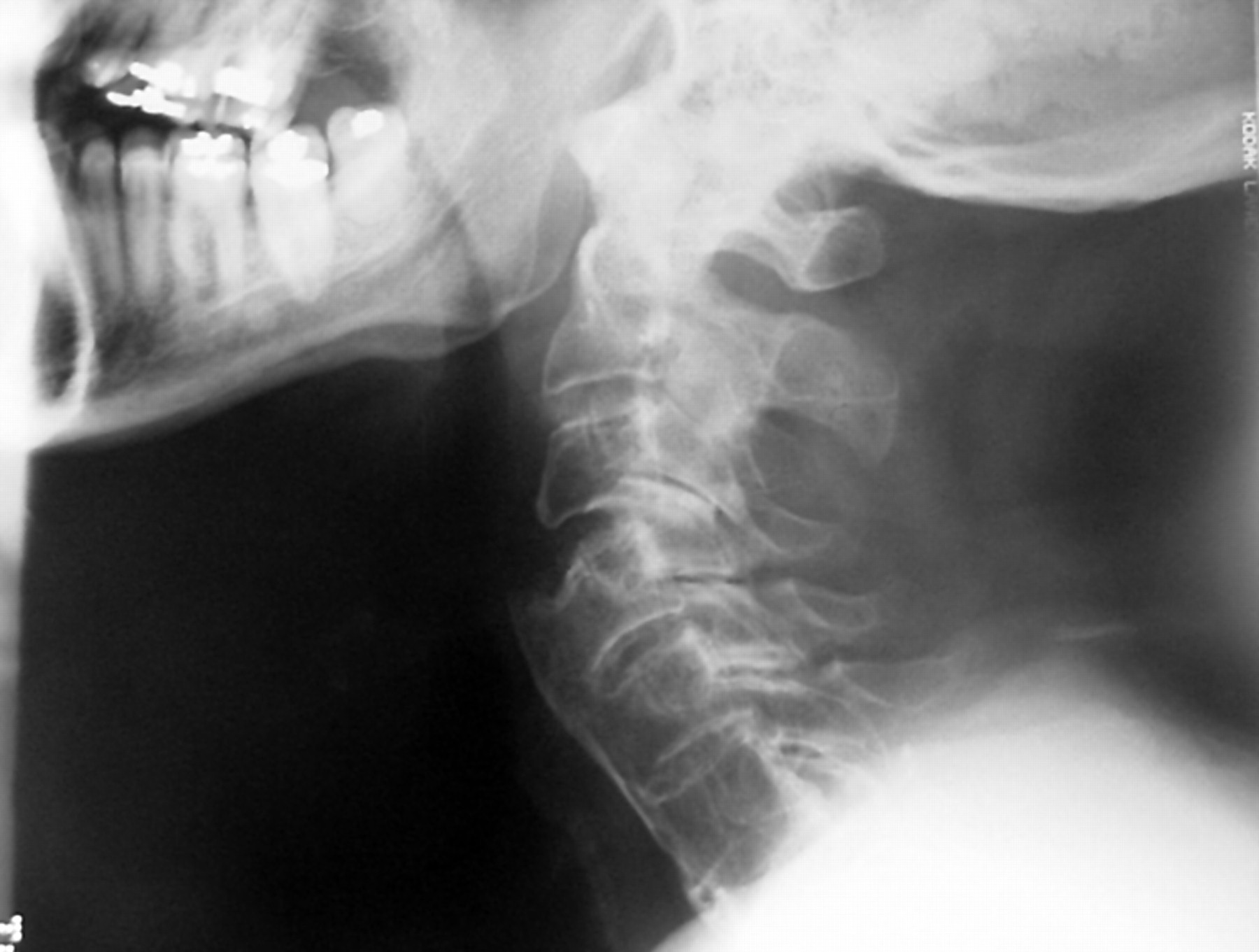 Unstable Cervical Spine Fracture