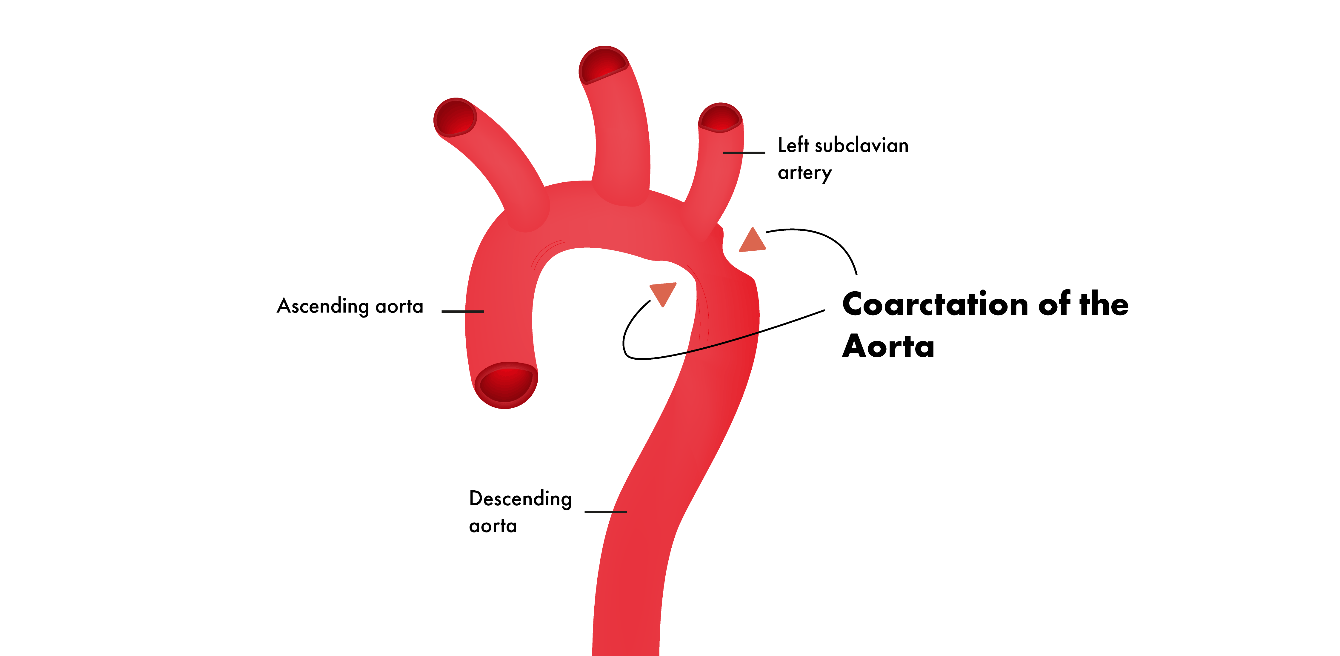 Coarctation Of The Aorta