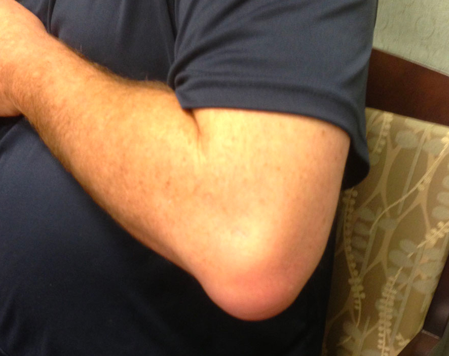 Why Is My Elbow Suddenly Swollen at Brian Isaacs blog
