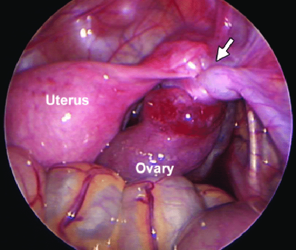 What Causes Cyst On Ovary During Pregnancy لم يسبق له مثيل الصور