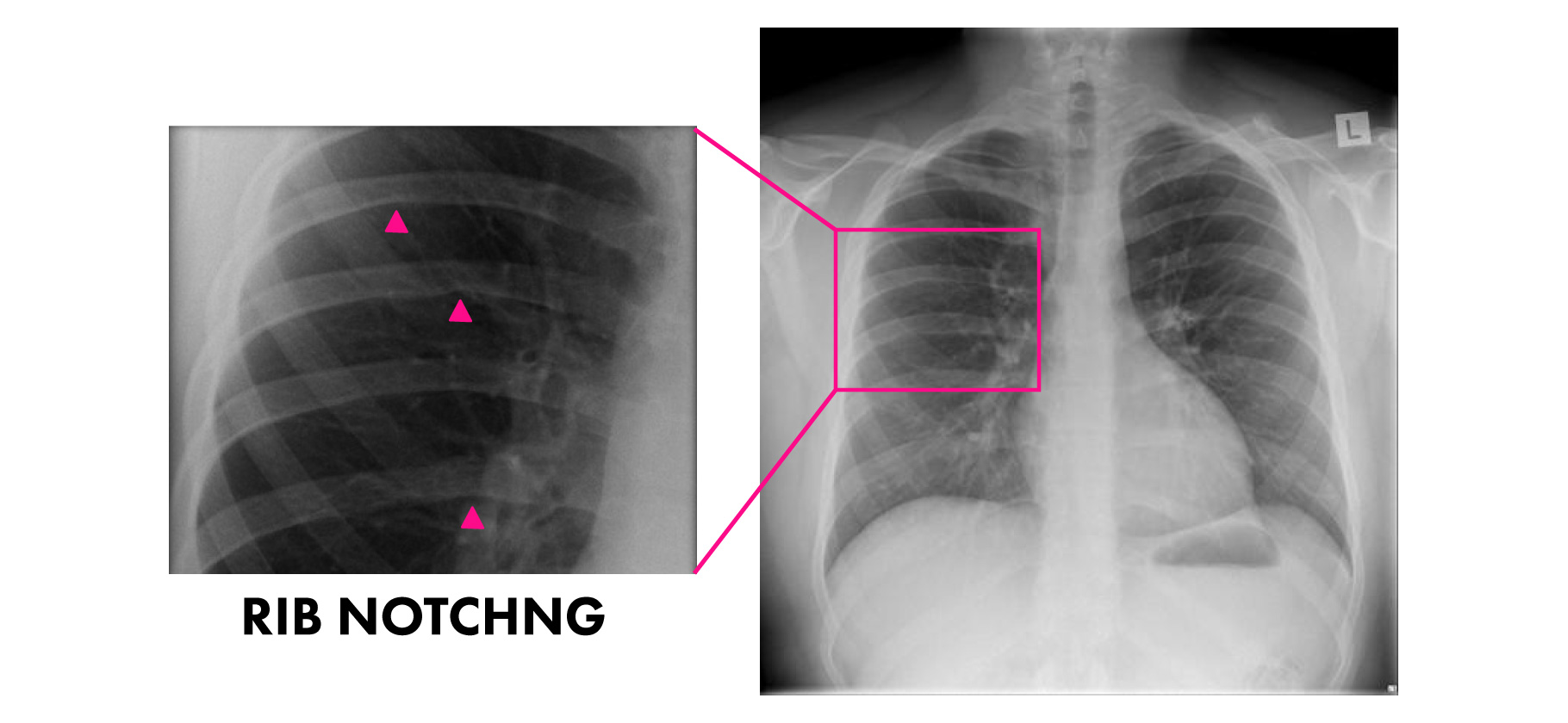 Coarctation of the Aorta
