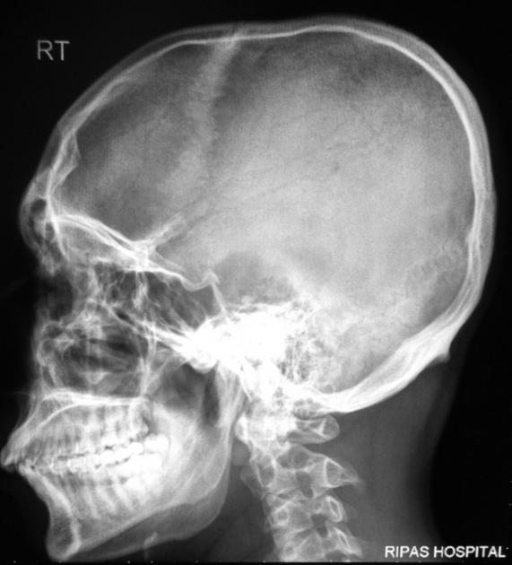 Basal Skull Fracture